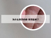 为什么突然的癣 突然起癣了