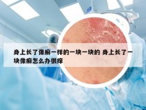 身上长了像癣一样的一块一块的 身上长了一块像癣怎么办很痒