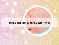 线状苔癣用治疗吗 线状苔藓是什么病