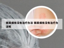 银屑病有没有治疗办法 银屑病有没有治疗办法呢