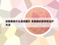 皮肤癣有什么症状图片 皮肤癣的症状和治疗方法