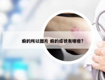 癣的所以图片 癣的症状有哪些?