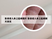 卧床老人身上起癣图片 卧床老人身上起癣图片真实