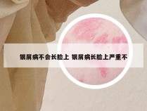 银屑病不会长脸上 银屑病长脸上严重不