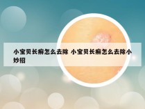 小宝贝长癣怎么去除 小宝贝长癣怎么去除小妙招