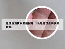 急性点滴状银血病图片 什么是急性点滴状银屑病