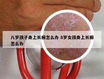 八岁孩子身上长癣怎么办 8岁女孩身上长癣怎么办