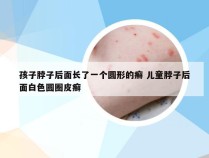 孩子脖子后面长了一个圆形的癣 儿童脖子后面白色圆圈皮癣