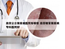 南京公立银屑病医院有哪些 南京哪家银屑病专科医院好