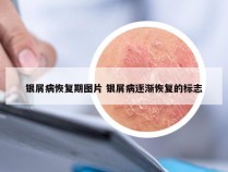 银屑病恢复期图片 银屑病逐渐恢复的标志