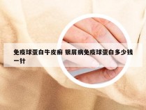 免疫球蛋白牛皮癣 银屑病免疫球蛋白多少钱一针