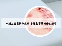 小腿上容易长什么癣 小腿上容易长什么癣呢