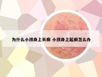 为什么小孩身上长癣 小孩身上起癣怎么办