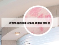 成都银屑病哪里治得好 成都看银屑病