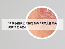 12岁小孩头上长癣怎么办 12岁儿童长头皮屑了怎么办?