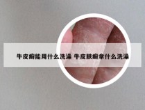 牛皮癣能用什么洗澡 牛皮肤癣拿什么洗澡