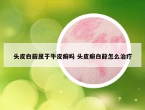 头皮白藓属于牛皮癣吗 头皮癣白藓怎么治疗