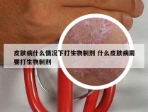 皮肤病什么情况下打生物制剂 什么皮肤病需要打生物制剂