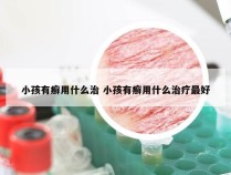 小孩有癣用什么治 小孩有癣用什么治疗最好