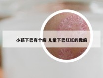 小孩下巴有个癣 儿童下巴红红的像癣