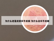 为什么老是皮肤长牛皮癣 为什么会长牛皮廨