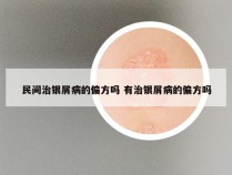 民间治银屑病的偏方吗 有治银屑病的偏方吗