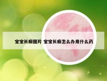 宝宝长癣图片 宝宝长癣怎么办用什么药