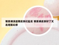 银屑病消退期皮损红起皮 银屑病皮损好了又出现新红疹