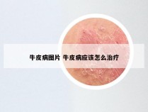 牛皮病图片 牛皮病应该怎么治疗