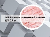 铜钱癣如何治疗 铜钱癣有什么症状?揭秘最佳治疗方法