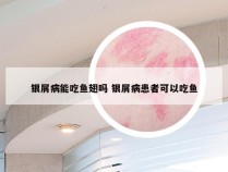 银屑病能吃鱼翅吗 银屑病患者可以吃鱼