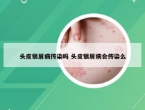 头皮银屑病传染吗 头皮银屑病会传染么