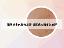 银屑病多久能恢复好 银屑病大概多久能好