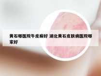 黄石哪医院牛皮癣好 湖北黄石皮肤病医院哪家好