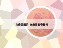 克癣灵图片 克癣王乳膏作用