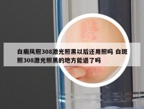 白癜风照308激光照黑以后还用照吗 白斑照308激光照黑的地方能退了吗