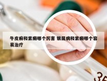 牛皮癣和紫癜哪个厉害 银屑病和紫癜哪个容易治疗