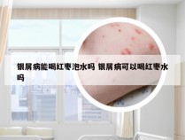 银屑病能喝红枣泡水吗 银屑病可以喝红枣水吗