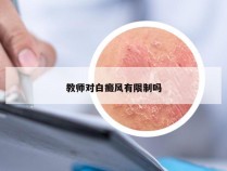 教师对白癜风有限制吗