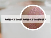 头癣都有那些症状 头癣都有那些症状和图片