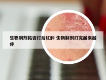 生物制剂拓咨打后红肿 生物制剂打完越来越疼