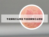 牛皮癣有什么特征 牛皮皮癣有什么特征