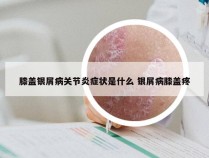 膝盖银屑病关节炎症状是什么 银屑病膝盖疼