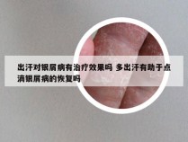 出汗对银屑病有治疗效果吗 多出汗有助于点滴银屑病的恢复吗