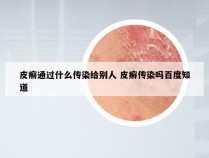 皮癣通过什么传染给别人 皮癣传染吗百度知道