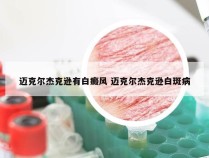 迈克尔杰克逊有白癜风 迈克尔杰克逊白斑病