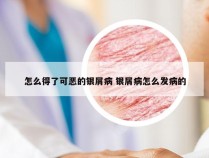 怎么得了可恶的银屑病 银屑病怎么发病的