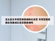 怎么区分寻常型银屑病和红皮型 寻常型银屑病会发展成红皮型银屑病吗