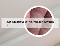 小孩长癣会传染 孩子长了癣,能自行恢复吗?