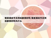 银屑病关节炎预后都很好吗 银屑病关节炎预后都很好吗为什么